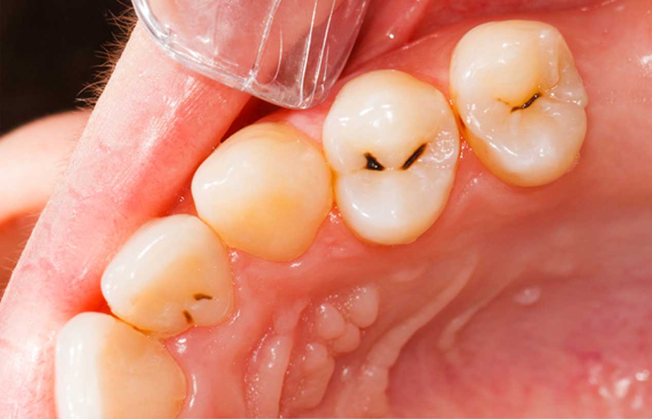 How Long Should It Take To Fill A Cavity