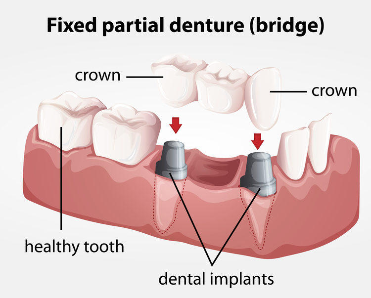 Fixed partial denture bridge