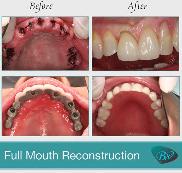 West Hollywood Full Mouth Reconstruction