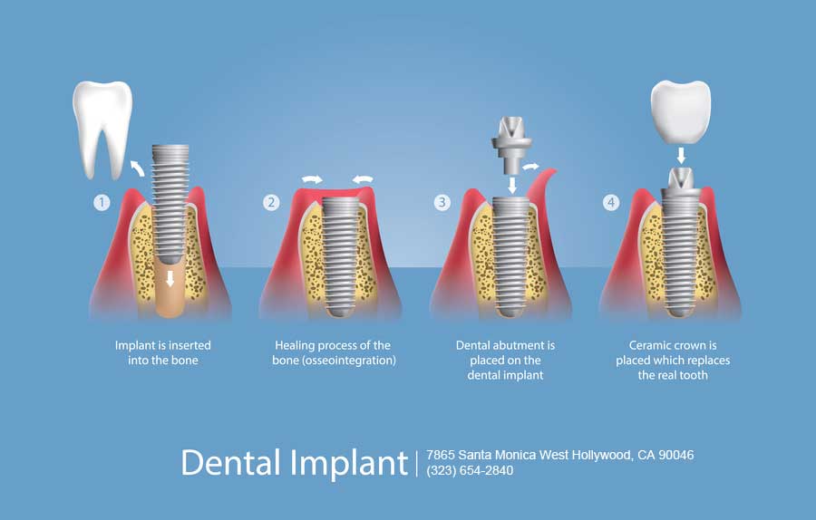 How to find Affordable Dental Implants in West Hollywood CA West