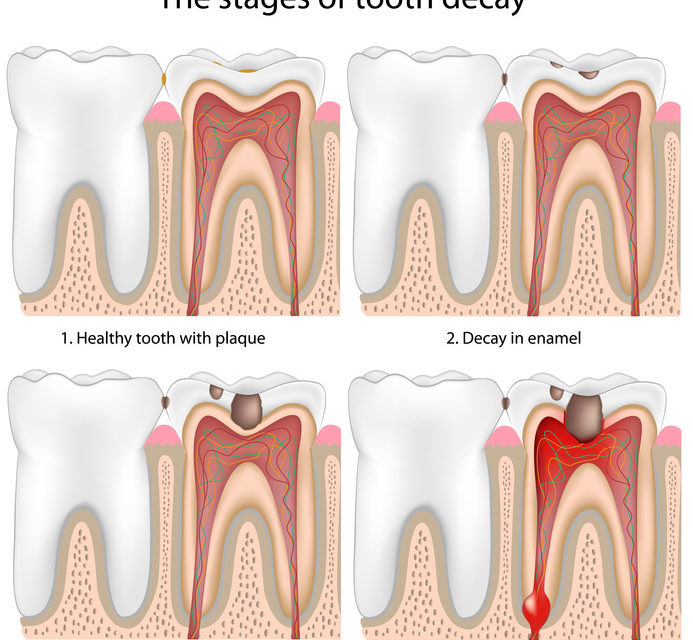 west hollywood root canal