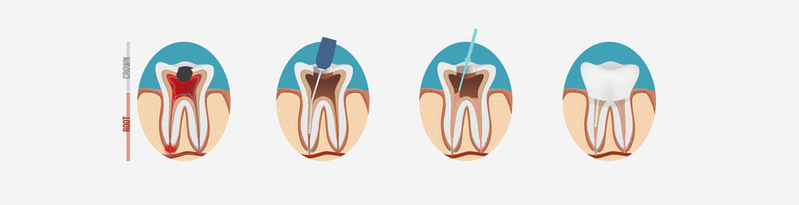 root canal west hollywood