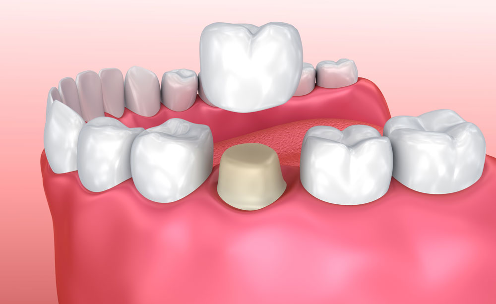 How Much Do Dental Crowns Usually Cost - Los Angeles Dental Crown Replacement Cost