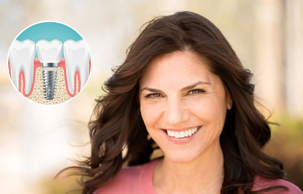dental implants options West Hollywood