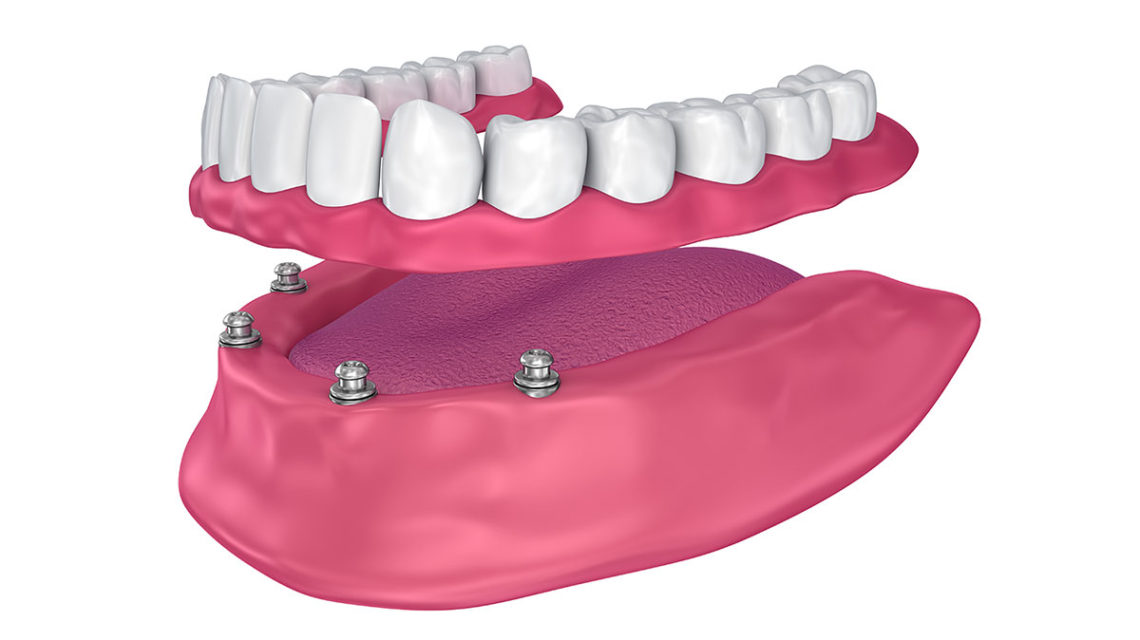 all on 4 dental implants West Hollywood