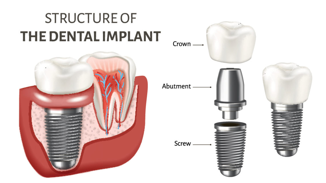structure of the dental implant