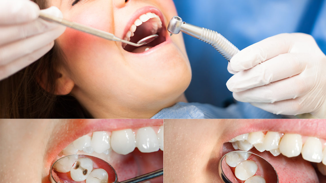 Finding the Best Material for Filling a Tooth Cavity - West Hollywood  Holistic and Cosmetic Dental Care