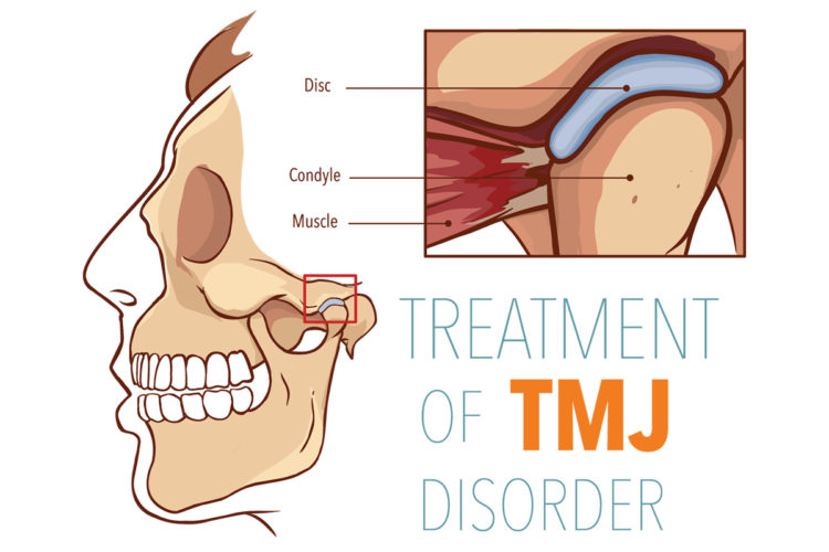 TMJ treatment options