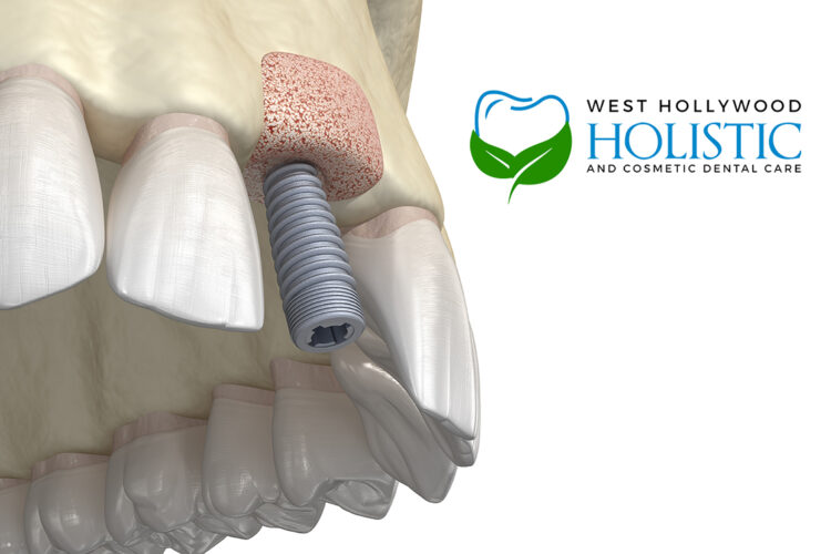 Bone Graft Dental Implants