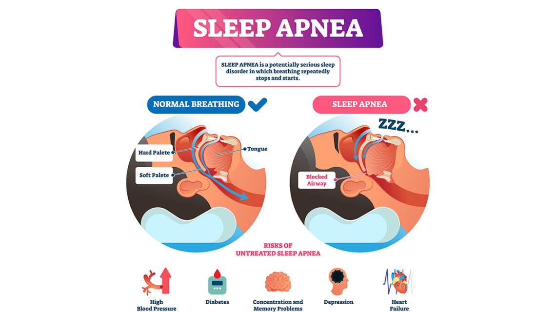 importance of sleep apnea treatment