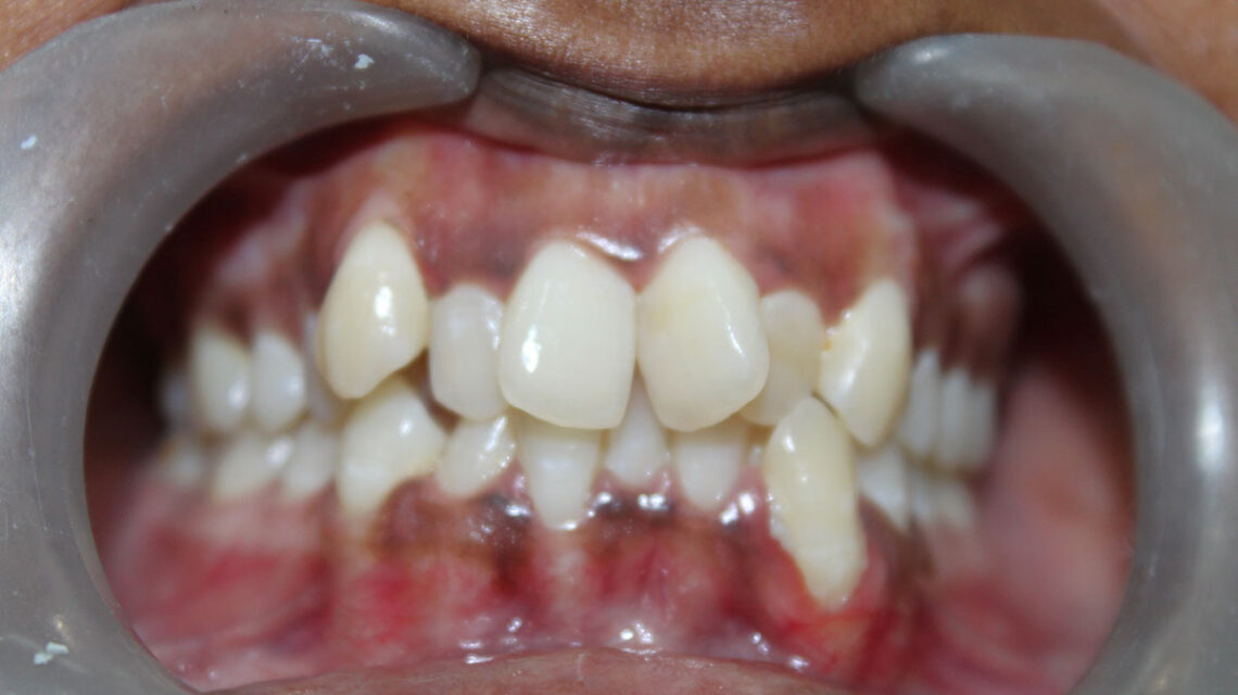 crowded teeth treatment