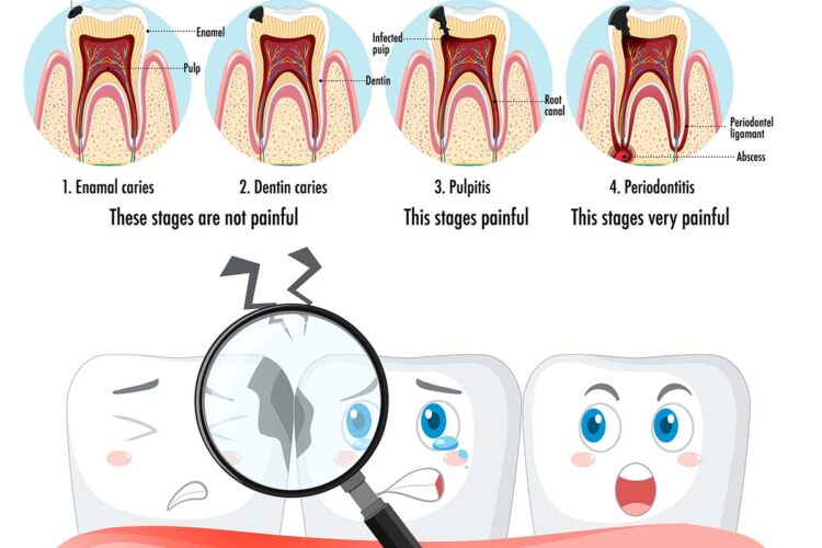 stages of caries development