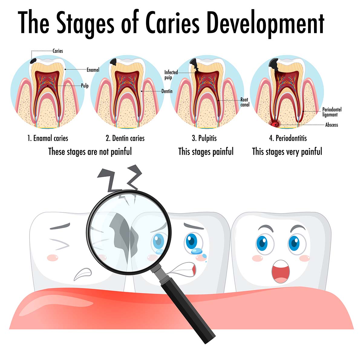 stages of caries development