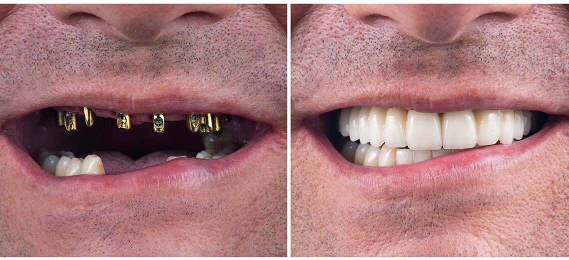full arch dental implants Beverly Hills