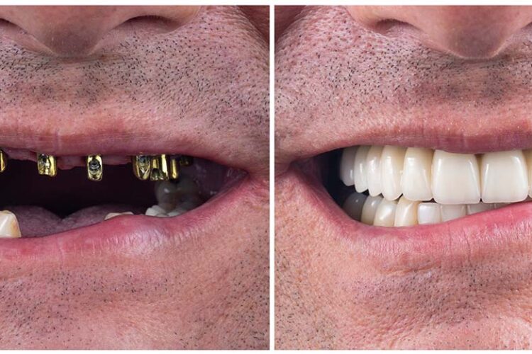 full arch dental implants Beverly Hills