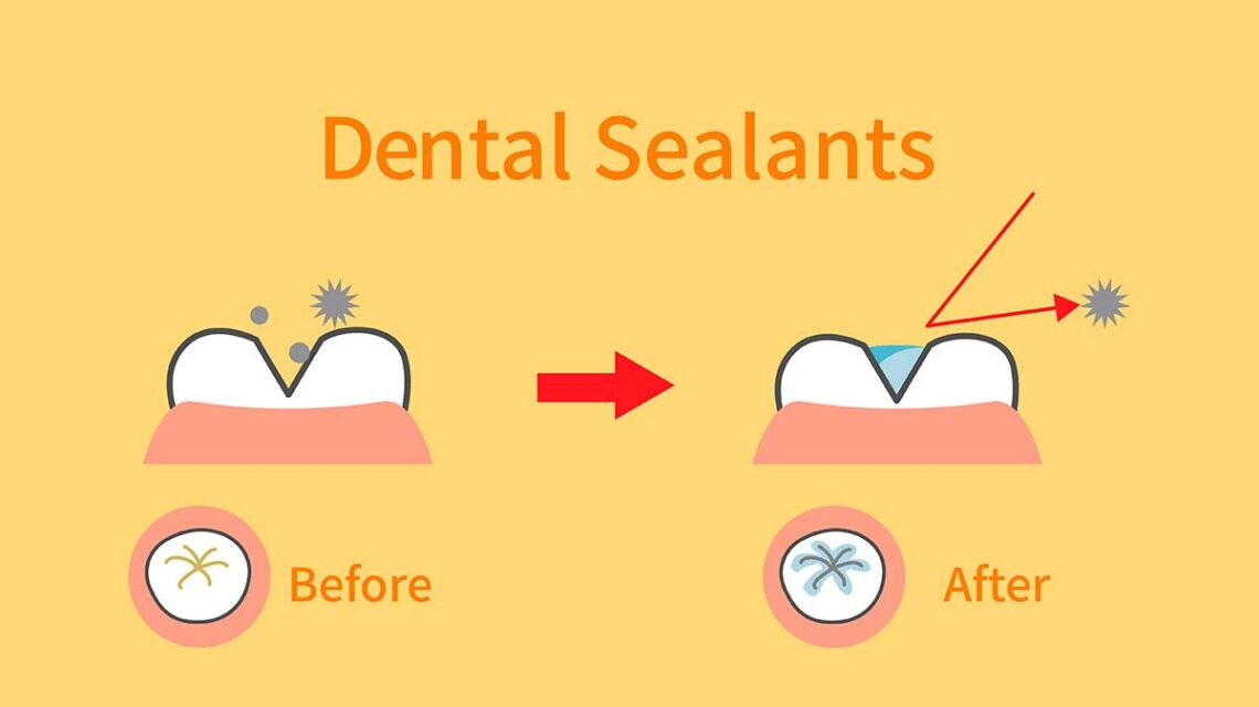 Dental Sealant for Kids