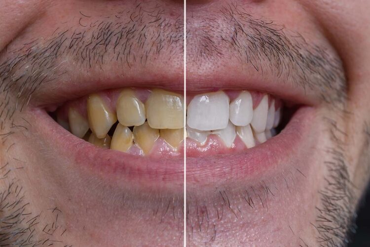 Yellow Teeth Treatment